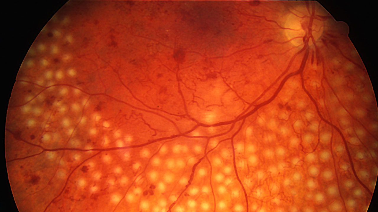 diabetic-retina-treatment
