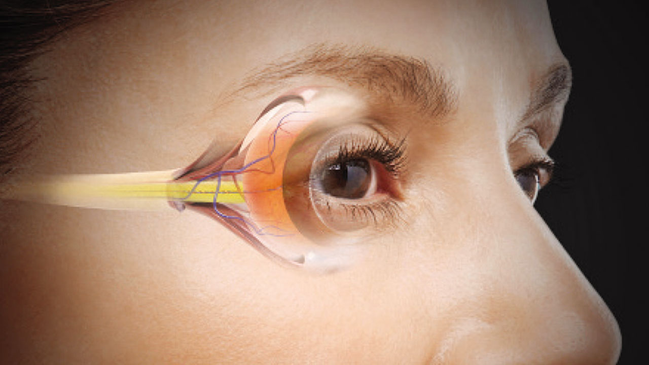 glaucoma-treatment